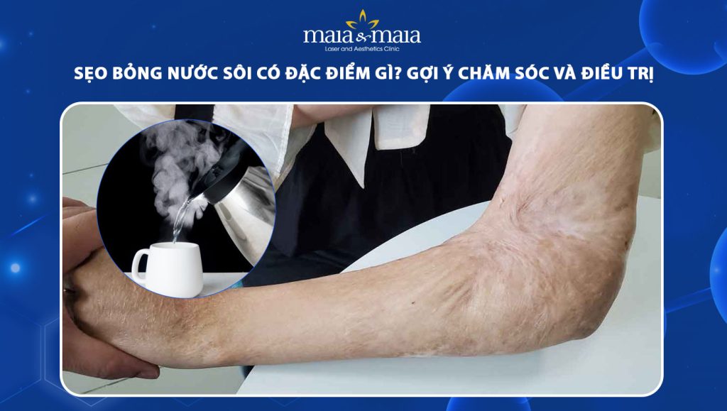 sẹo bỏng nước sôi