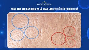sẹo đáy nhọn và lỗ chân lông to