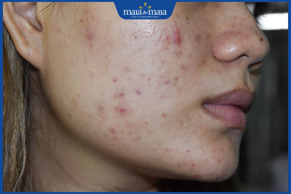 Cách chăm sóc da bị sẹo rỗ tại nhà giúp cải thiện bề mặt da hiệu quả 4 sẹo kèm thâm mụn