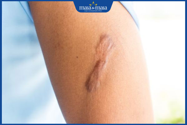 sẹo lồi sau trầy xước