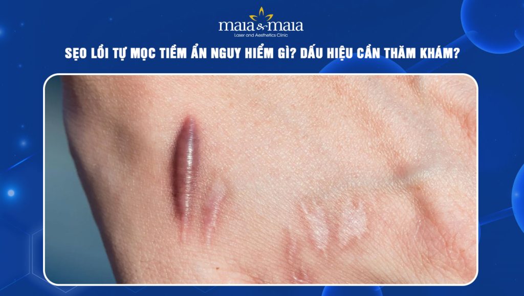 sẹo lồi tự mọc
