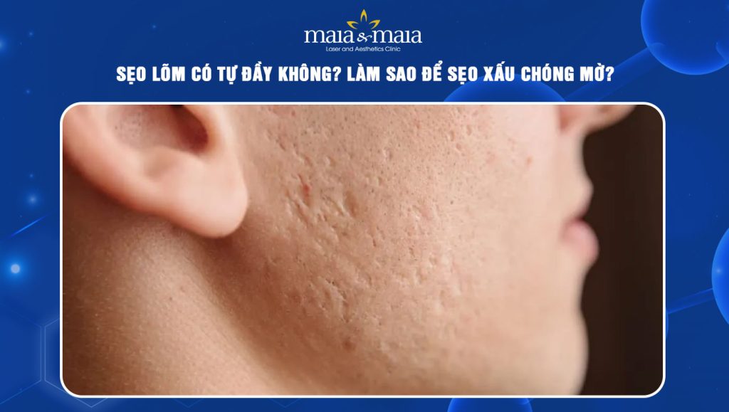 sẹo lõm có tự đầy không