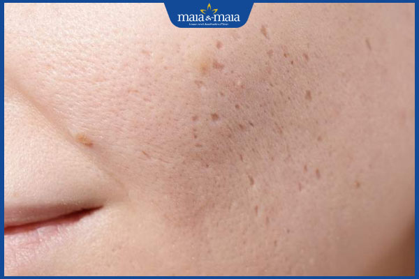 sẹo lõm đáy tròn