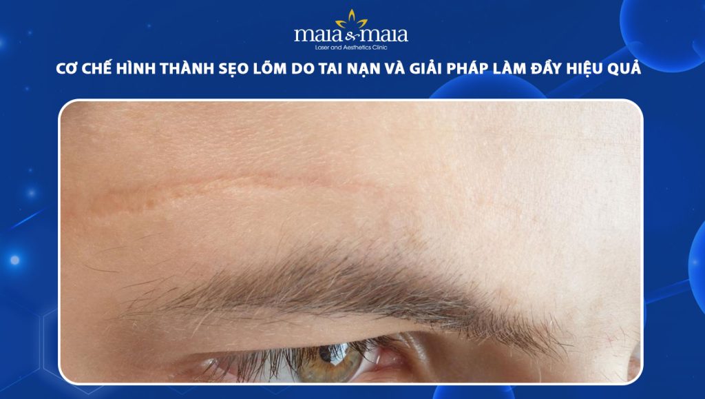 Cơ chế hình thành sẹo lõm do tai nạn & cách làm đầy hiệu quả 1 sẹo lõm do tai nạn