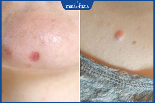 Chuyên gia tư vấn cách chữa sẹo lõm sau khi tẩy nốt ruồi 2 sẹo lõm do tẩy nốt ruồi