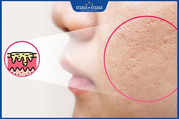 sẹo lõm không tự đầy