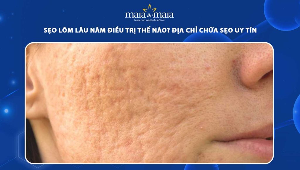 sẹo lõm lâu năm