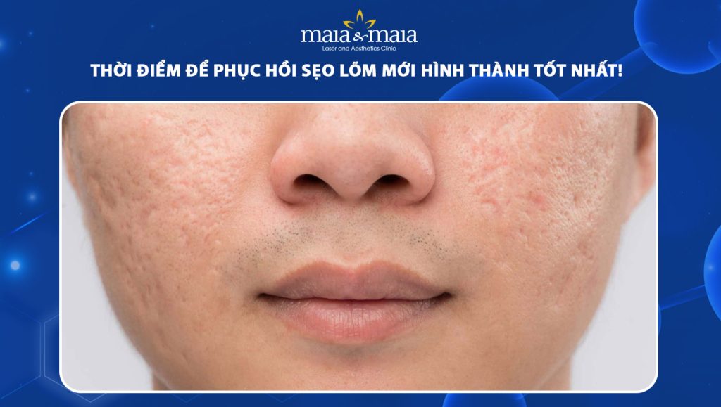 sẹo lõm mới hình thành