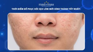 sẹo lõm mới hình thành