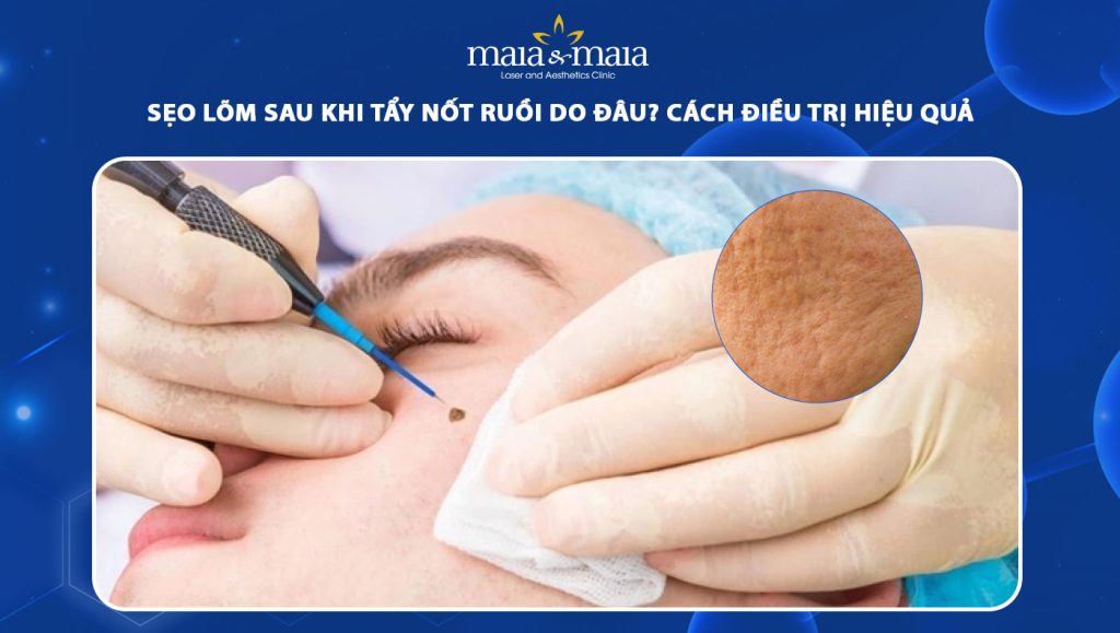 Sẹo lõm sau khi tẩy nốt ruồi do đâu? Cách điều trị hiệu quả 1 sẹo lõm sau khi tẩy nốt ruồi
