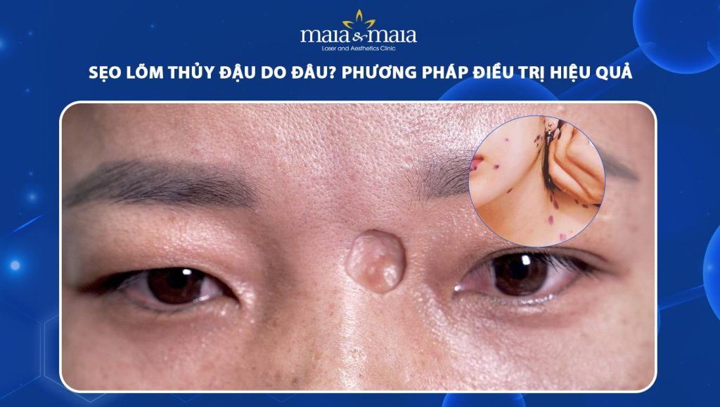 Sẹo lõm thủy đậu do đâu? Phương pháp điều trị hiệu quả 1 sẹo lõm thủy đậu