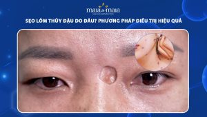 sẹo lõm thủy đậu