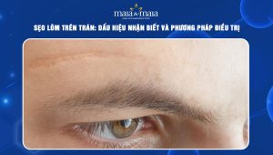 sẹo lõm trên trán