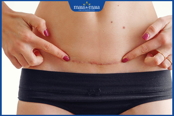 sẹo mổ đẻ