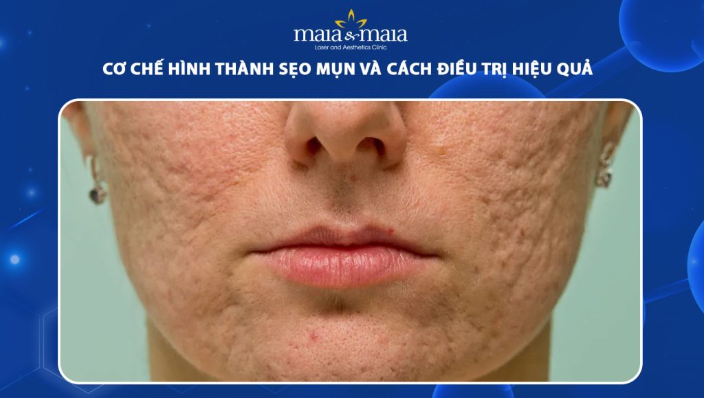 Cơ chế hình thành sẹo mụn và cách điều trị hiệu quả 1 sẹo mụn