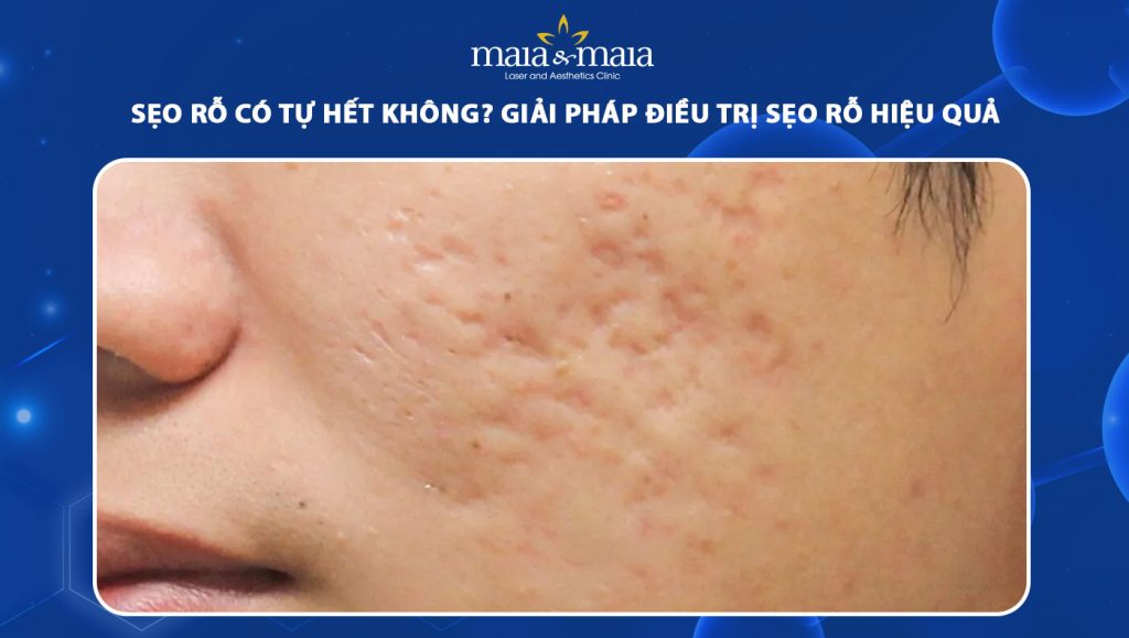 Sẹo rỗ có tự hết không? Giải pháp điều trị sẹo rỗ hiệu quả 1 sẹo rỗ có tự hết không