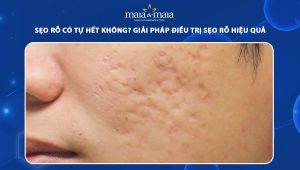 sẹo rỗ có tự hết không