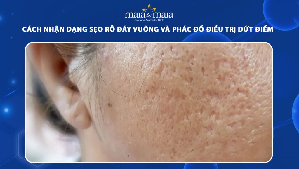 Cách nhận dạng sẹo rỗ đáy vuông và phác đồ điều trị dứt điểm 1 sẹo rỗ đáy vuông