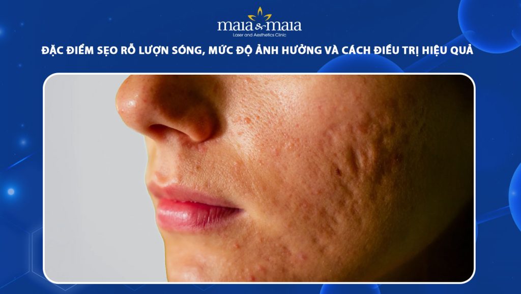 Đặc điểm sẹo rỗ lượn sóng, mức độ ảnh hưởng và cách xử lý 1 sẹo rỗ lượng sóng