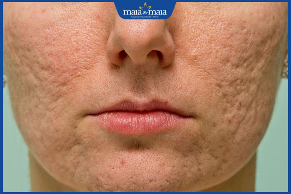 Tổng hợp 7+ loại kem trị sẹo lõm được ưa chuộng hiện nay 6 sẹo rỗ nặng