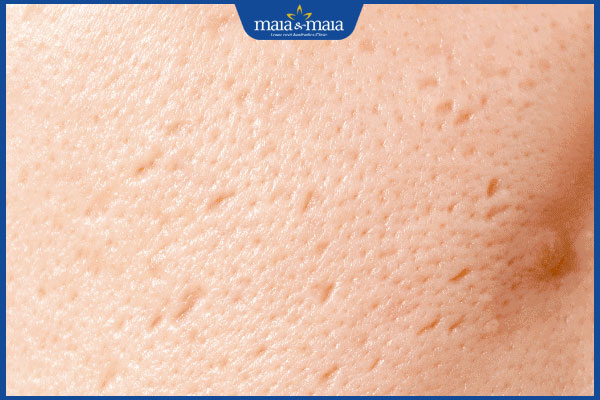 Trị sẹo rỗ bằng vitamin E có hiệu quả không? 5 cách đơn giản 5 sẹo rỗ nhẹ