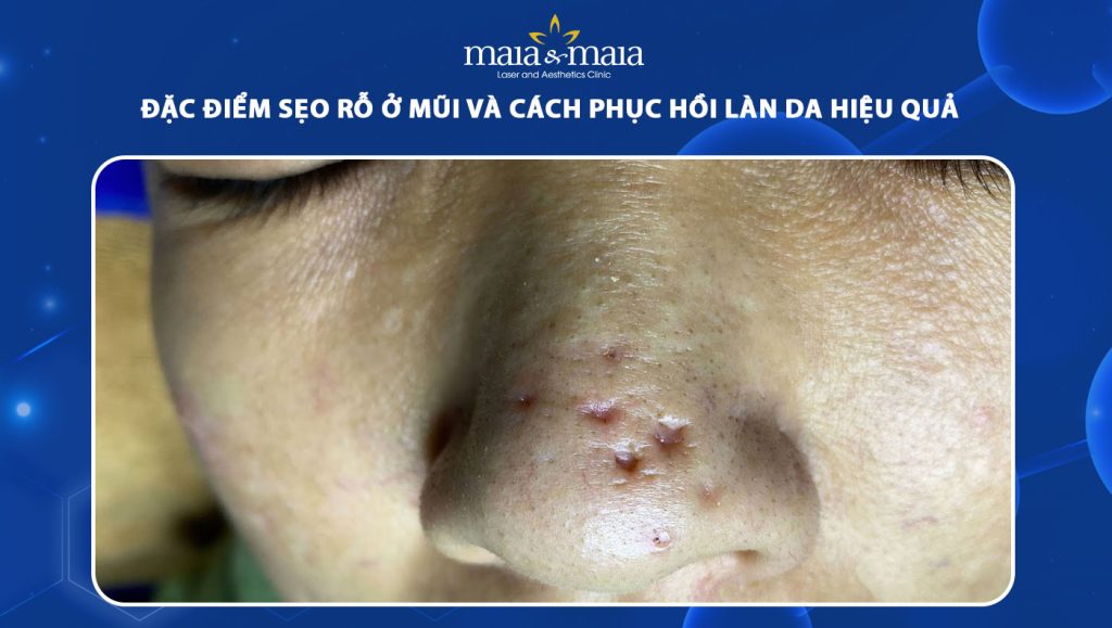 sẹo rỗ ở mũi