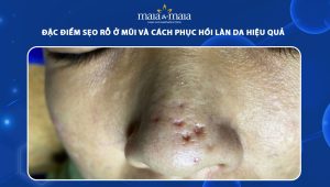 sẹo rỗ ở mũi