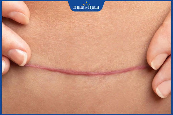 sẹo sau sinh mổ đã lành