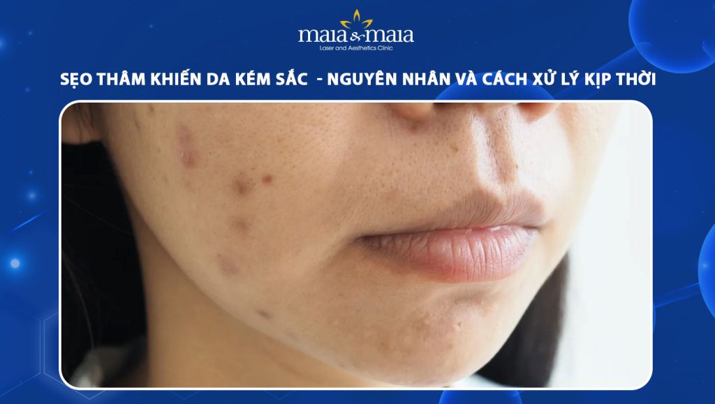 Sẹo thâm khiến da kém sắc: Nguyên nhân và cách xử lý kịp thời 1 sẹo thâm
