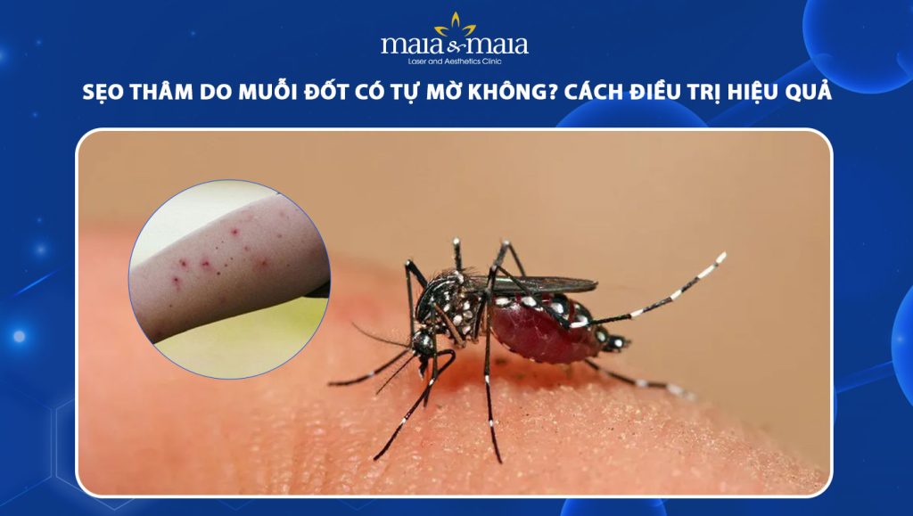 sẹo thâm do muỗi đốt