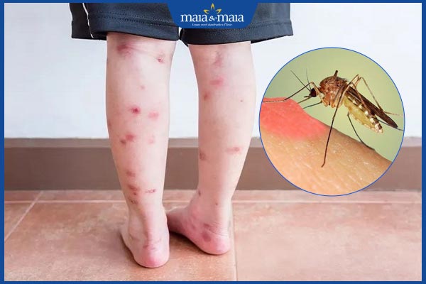 sẹo thâm do muỗi