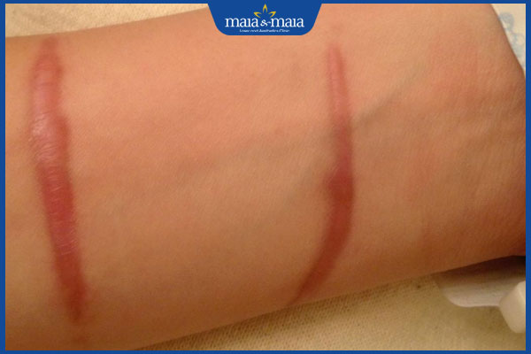 sẹo thâm đỏ tự mờ