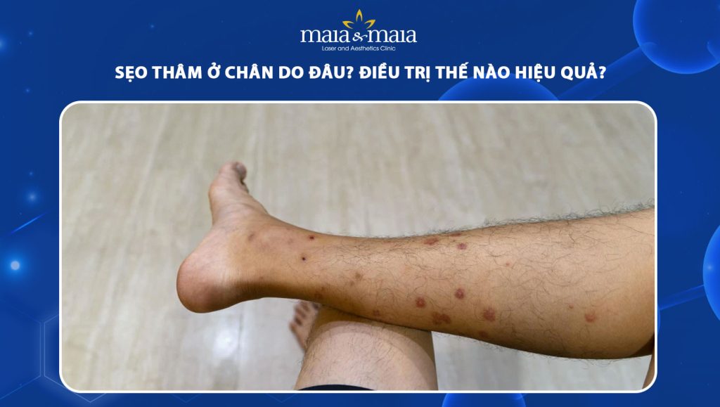 sẹo thâm ở chân