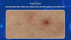 sẹo thâm sau khi tẩy nốt ruồi