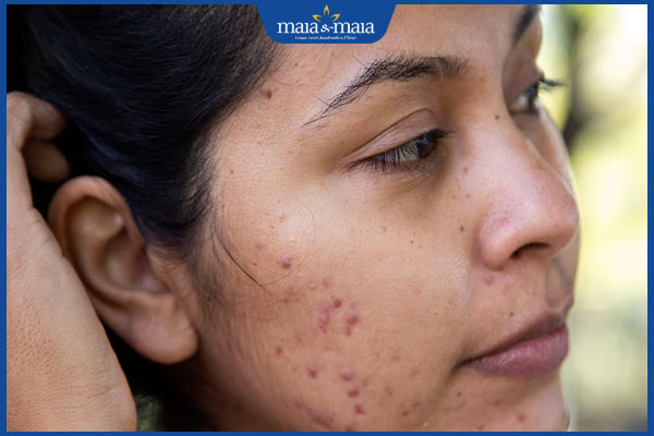 Sẹo thâm khiến da kém sắc: Nguyên nhân và cách xử lý kịp thời 3 sẹo thâm trên mặt