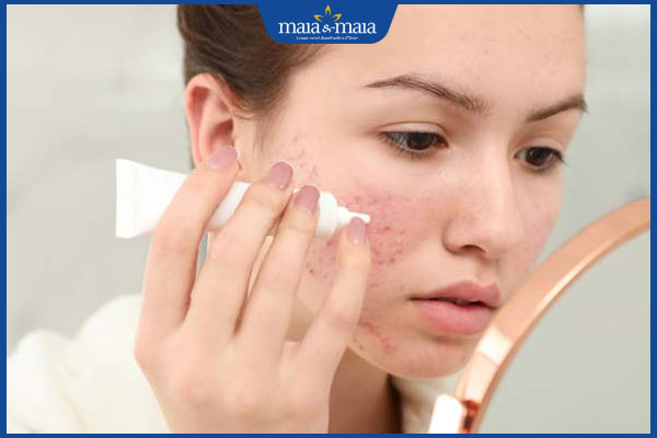 Sẹo lõm thủy đậu do đâu? Phương pháp điều trị hiệu quả 3 tác dụng kem xóa sẹo