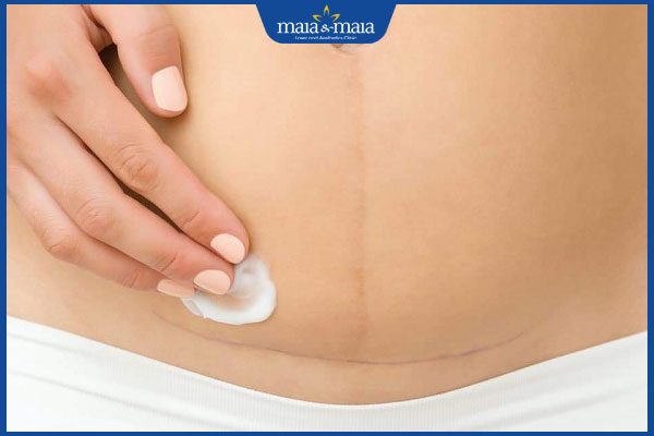 thoa kem trị sẹo sinh mổ