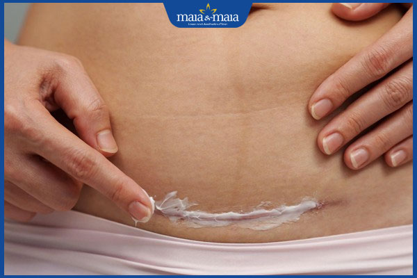 Khi nào thì dùng thuốc chống sẹo? Bí quyết giúp da nhanh lành sẹo 2 thoa kem trị sẹo