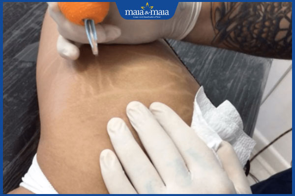 Xăm màu da che sẹo: Giải pháp hiệu quả hay rủi ro tiềm ẩn? 4 tiến hành xăm