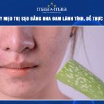 trị sẹo bằng nha đam