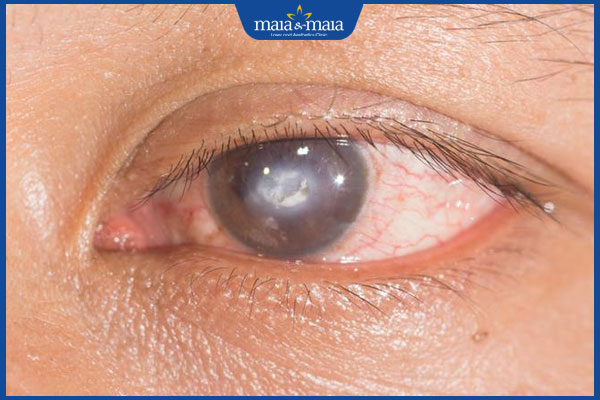 Trị sẹo giác mạc bằng laser: Giải pháp cải thiện thị thực an toàn 2 trị sẹo giác mạc