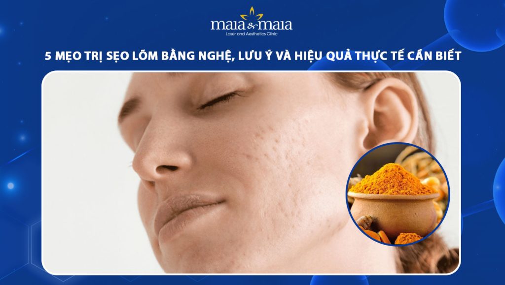 trị sẹo lõm bằng nghệ