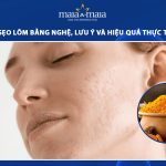 trị sẹo lõm bằng nghệ