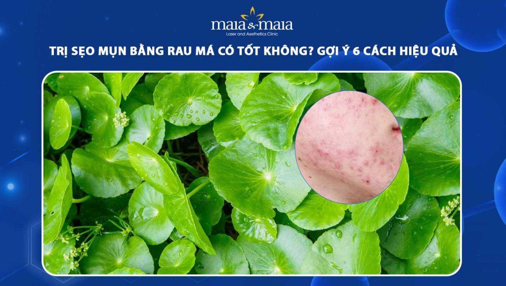 trị sẹo mụn bằng rau má