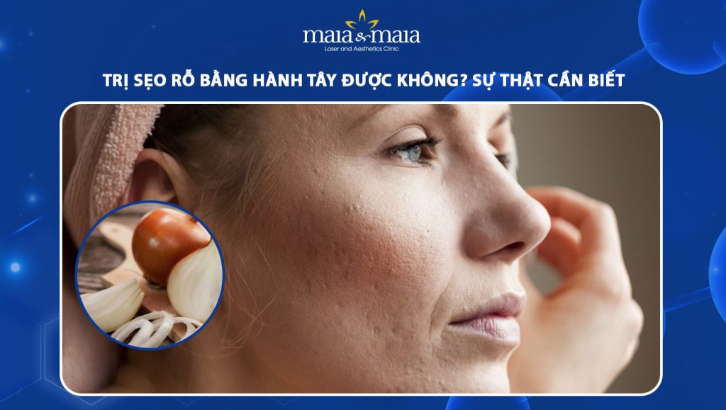 trị sẹo rỗ bằng hành tây