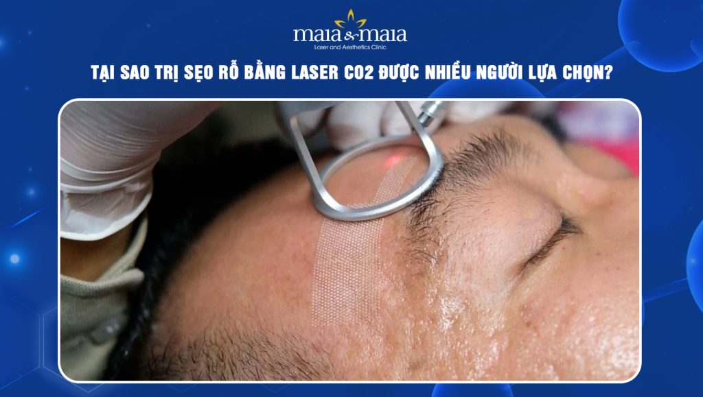Trị sẹo rỗ bằng laser CO2 có tốt không? Có tác dụng phụ gì? 1 trị sẹo rỗ bằng laser co2