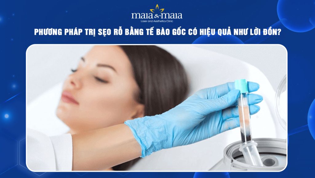 trị sẹo rỗ bằng tế bào gốc