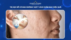 trị sẹo rỗ có đau không