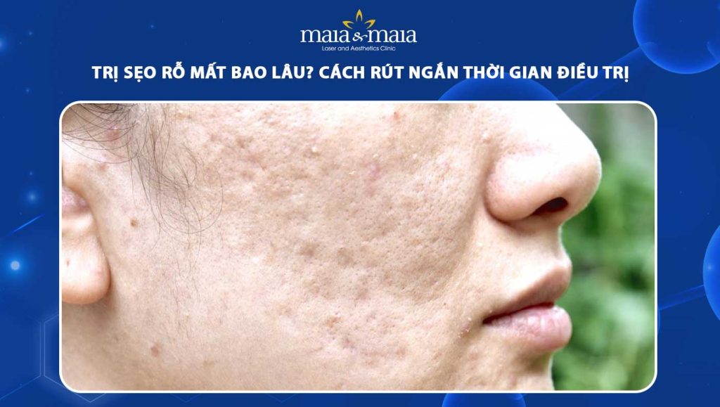 Trị sẹo rỗ mất bao lâu? Cách rút ngắn thời gian điều trị 1 trị sẹo rỗ mất bao lâu