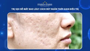 trị sẹo rỗ mất bao lâu